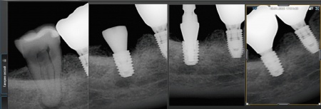 удаление зуба и отсроченая имплантация