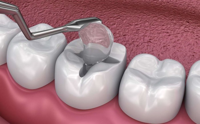 Косметическая реставрация и восстановление зубов